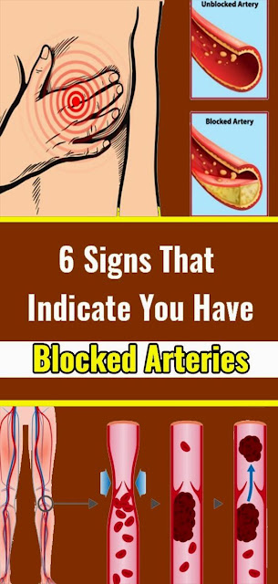 6 Signs That Indicate You Have Blocked Arteries Word